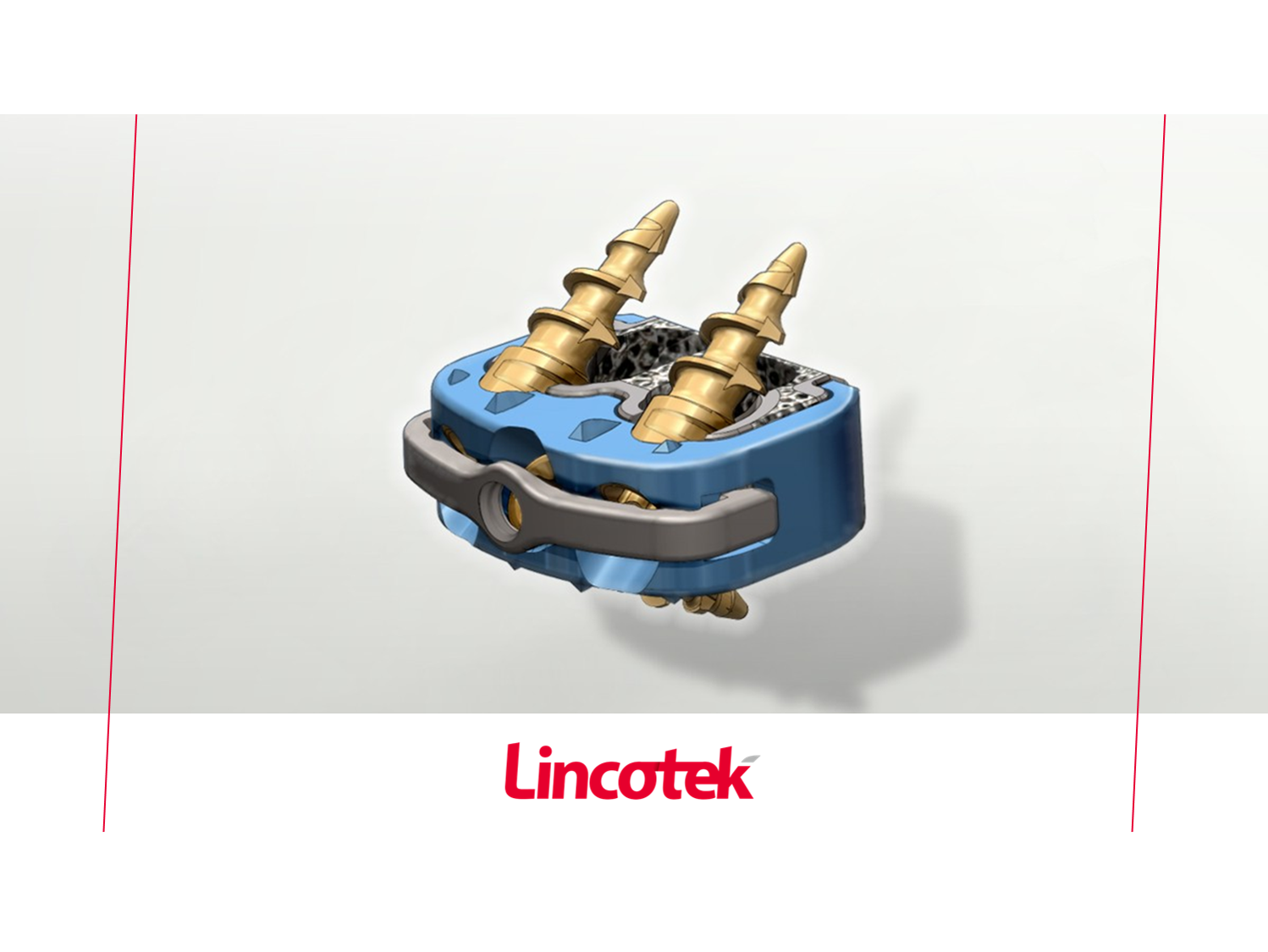 Lincotek 医疗事业部新型颈椎植入系统获 FDA 510K批准